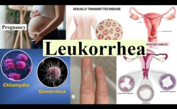 Leukorrhea